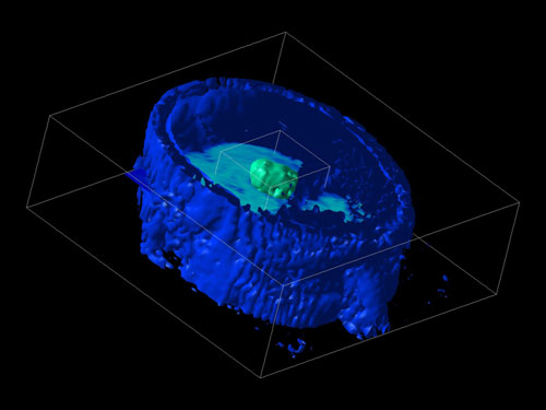 MRI brain scan showing image manipulation to 'remove' tissues