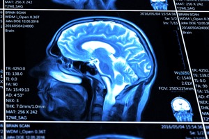 blue MRI brain scan